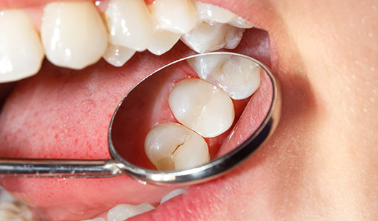 gentle root fillings by dentist in jersey