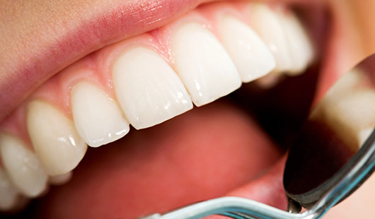 tooth extraction and root fillings, dentist in St Helier, Jersey